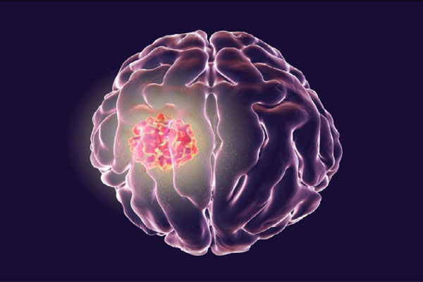 抗脑癌,量子疗法,胶质母细胞瘤